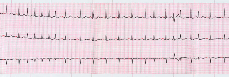 ECG with short paroxysms of atrial fibrillation