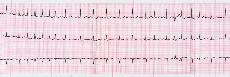 ECG with short paroxysms of atrial fibrillation