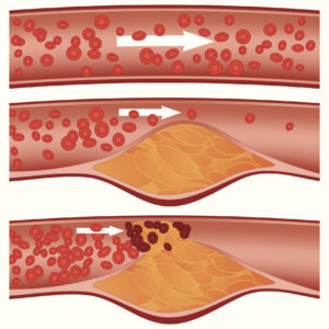 plaque buildup in the arteries