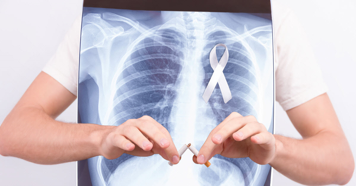 For Lung Cancer Awareness Month, be aware that your number one risk for getting lung cancer is smoking — but if you have smoked the equivalent of a pack a day for 30 years, a lung cancer screening can help detect cancer early when it is most treatable.