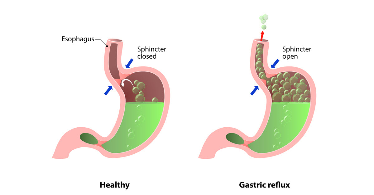 Although still rare, there has been a rising incidence rate of esophageal adenocarcinoma, a type of cancer linked with a condition that is very common: reflux disease.