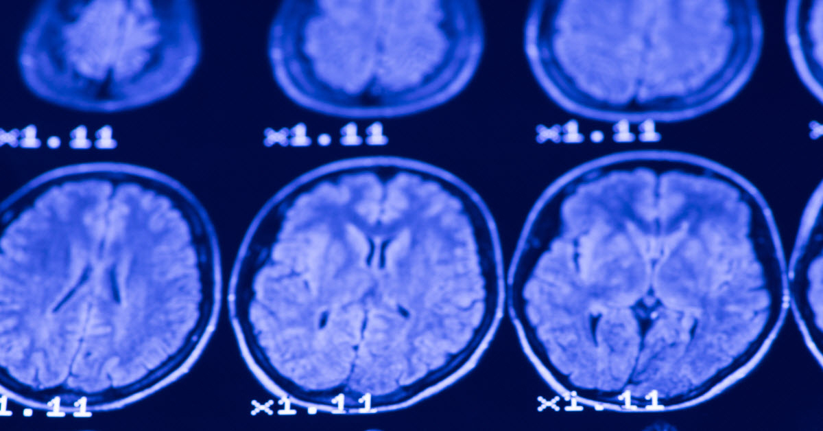 No one test can determine if a person has multiple sclerosis; a MRI of the brain may be one piece of a larger diagnostic puzzle that the neurologist must put together.