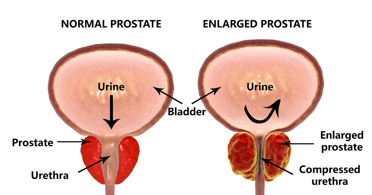 some men develop an enlarged prostate as they get older
