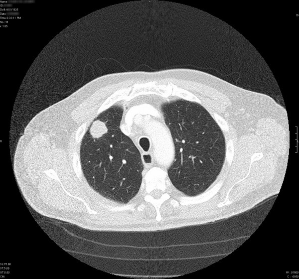 A CT scan showing lung cancer