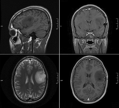 Xrays of the brain